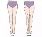「假胯宽」让腿型很难看 90%的女生都有这个问题